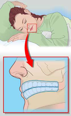 Digrigni i denti? Tensione alla mascella, dolori alle tempie, alla base del cranio e alla cervicale?