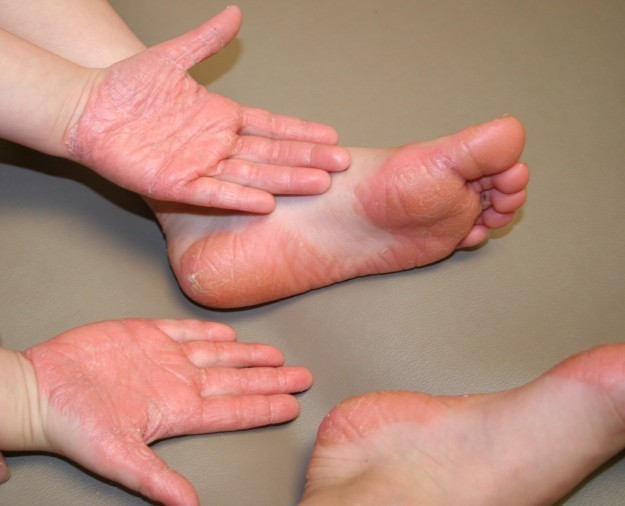 Imbarazzo per sudorazione eccessiva (iperidrosi): alle mani, ai piedi, sotto le ascelle? Sistema il tuo metabolismo con la RIFLESSOLOGIA PLANTARE basato sulla Medicina Tradizionale Cinese