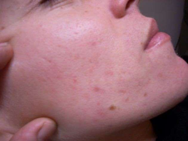 Drenaggio coppettazione viso per impurità dei tessuti