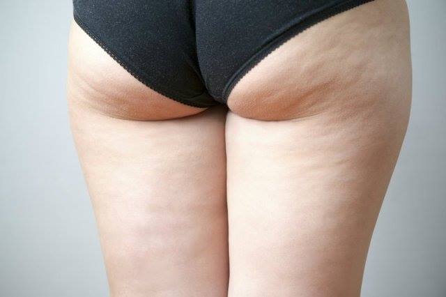 Massaggio a coppettazione per problemi di cellulite, adipe e ritenzione idrica