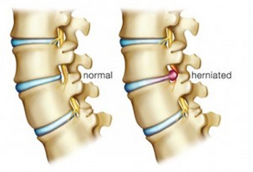 Fisioterapia e osteopatia con ernia discale